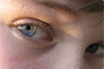 asperger